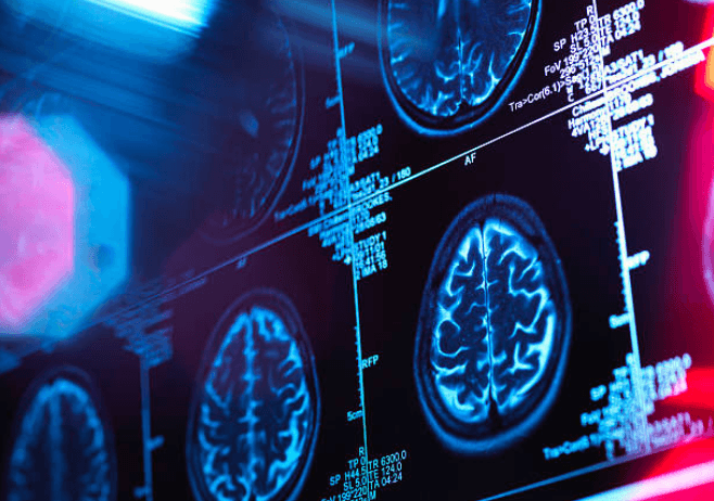 Long-Term Nerve and Brain Health Depends on Specialised Neurological Care