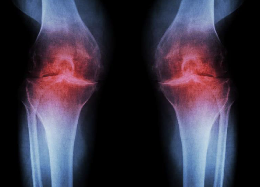 People think knee pain is inevitable as they age. That may not be the case.