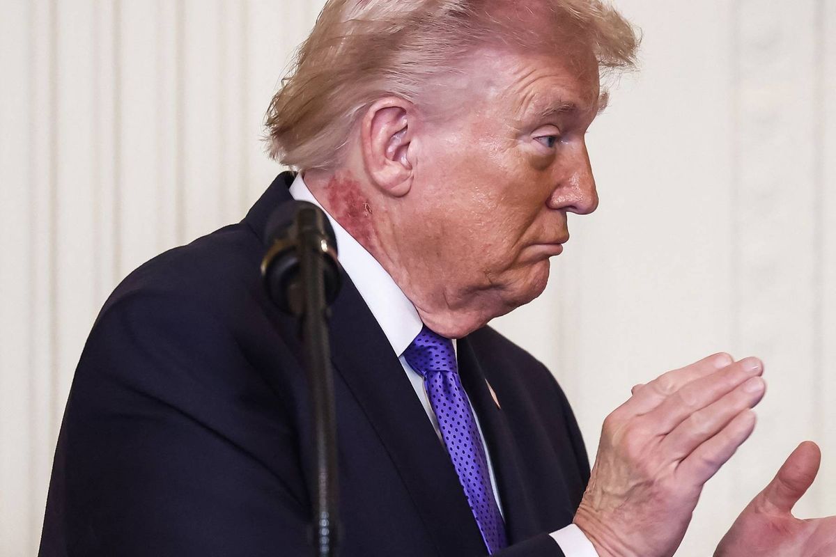 Trump health concerns spike as rash, bruises and limp raise fitness questions