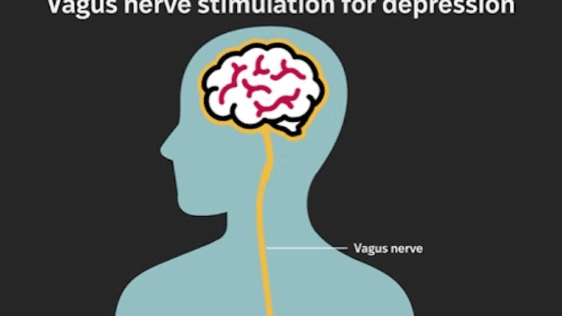 Implant Provides Lasting Relief for Treatment-Resistant Depression