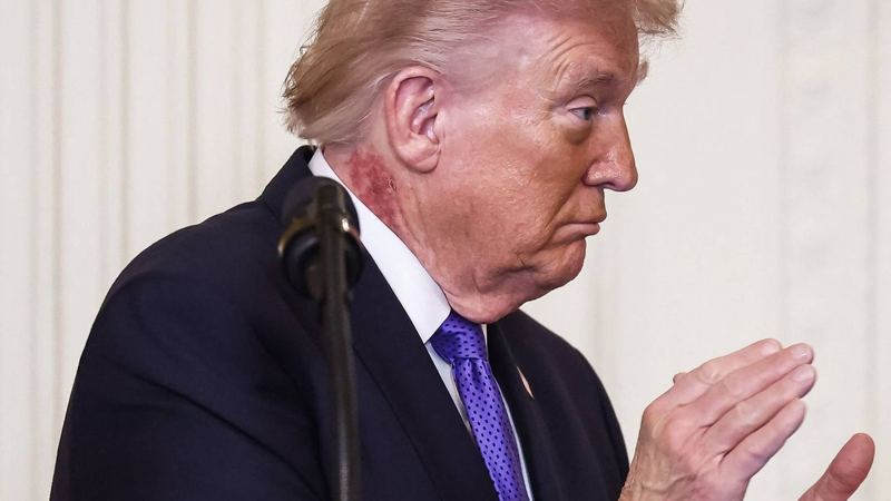 Trump health concerns spike as rash, bruises and limp raise fitness questions