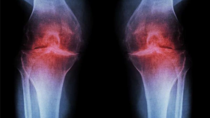People think knee pain is inevitable as they age. That may not be the case.