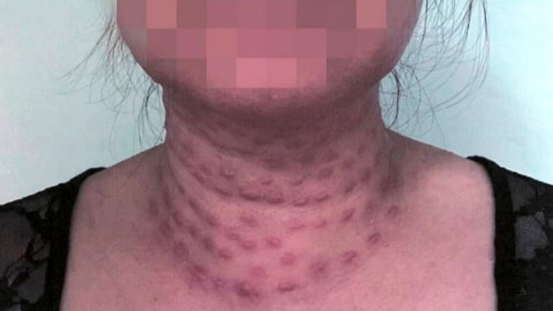 Bad Botox, failed fillers: Unlicensed medical spas causing harm, Long Island doctors say