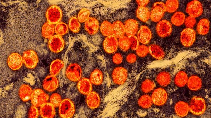 San Francisco Reports Its First Clade I Mpox Case — What to Know and How to Find a Vaccine