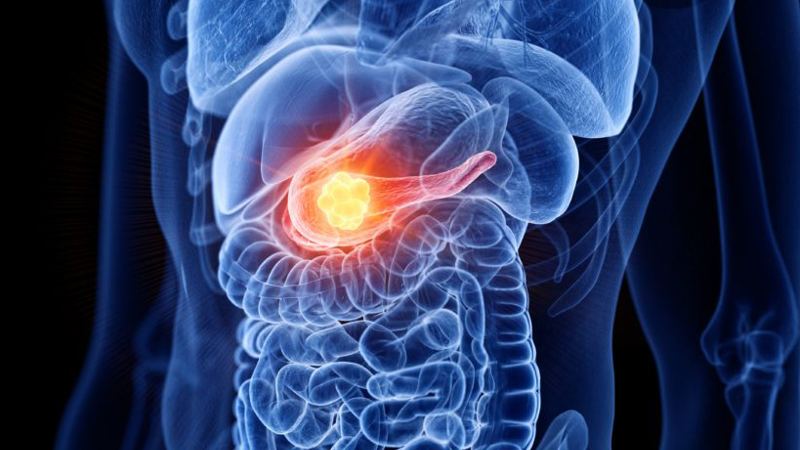 StockWatch: Revolution’s Phase III Pancreatic Cancer Data Dazzles Investors, Analysts