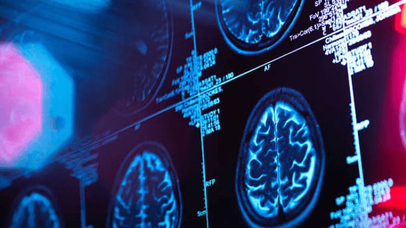 Long-Term Nerve and Brain Health Depends on Specialised Neurological Care